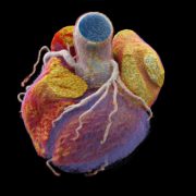 CT 3D Darstellung des Herzens