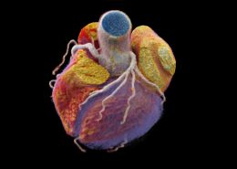 CT 3D Darstellung des Herzens