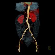 CT-Angiographie der Bauch- und Beckengefäße