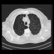 CT Darstellung Lungengewebe