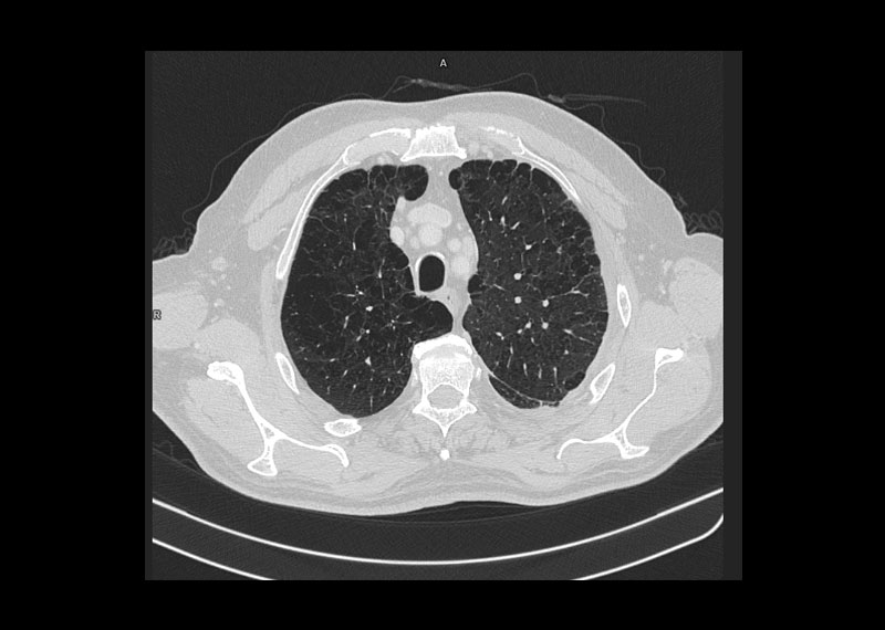 CT Darstellung Lungengewebe