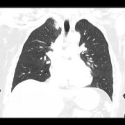 CT der Lunge