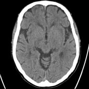 CT des Gehirns
