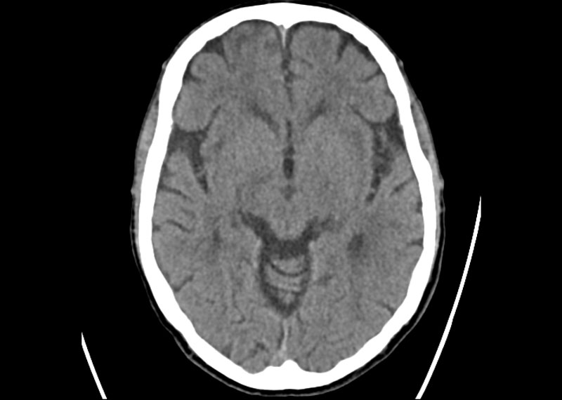 CT des Gehirns